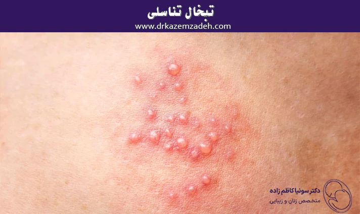 تبخال تناسلی