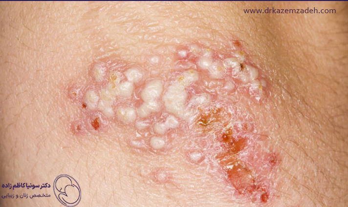 علائم تبخال تناسلی