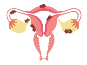 بهترین درمان برای فیبروم