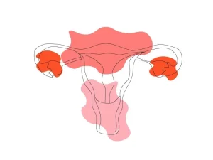 فیبروم رحم سرطان است