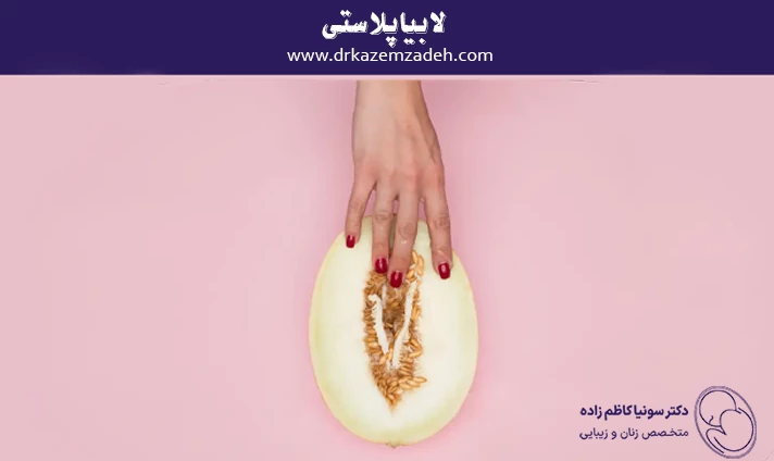 لابیاپلاستی