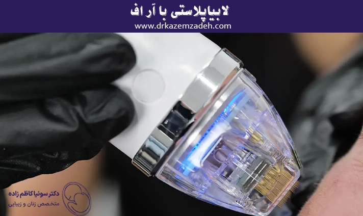 لابیاپلاستی با آر اف