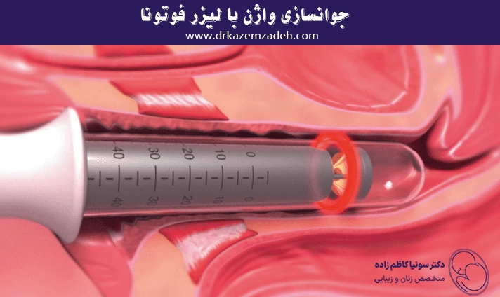 جوانسازی واژن با لیزر فوتونا