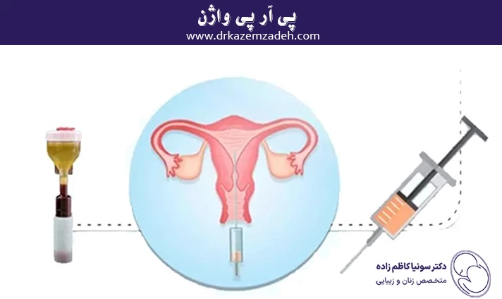 پی آر پی واژن