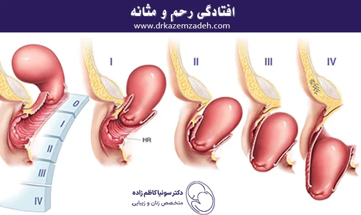 افتادگی رحم و مثانه