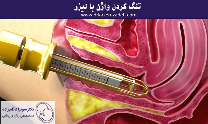 تنگ کردن واژن با لیزر