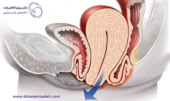 علائم افتادگی رحم و مثانه
