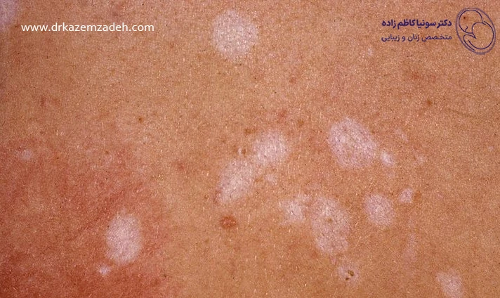 علائم لیکن اسکلروز واژن