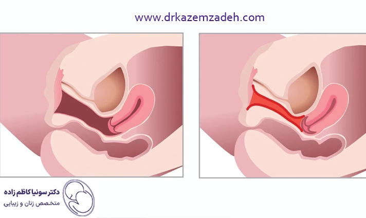 مزایای تنگ کردن واژن با لیزر