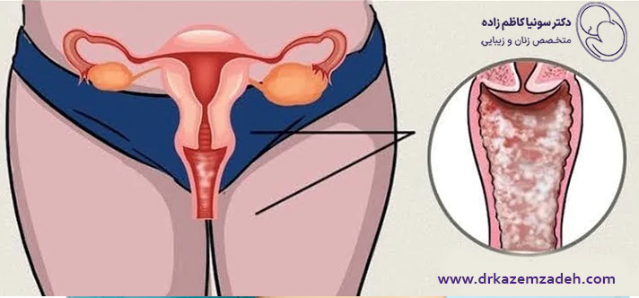 دکتر عفونت واژن