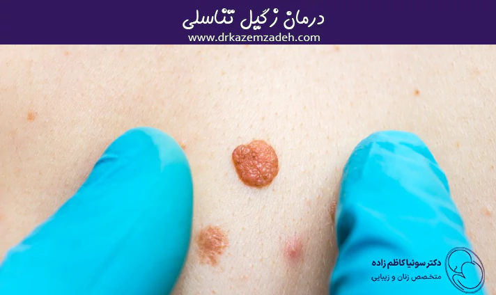 درمان زگیل تناسلی