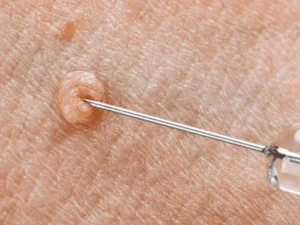 روش های درمان زگیل تناسلی