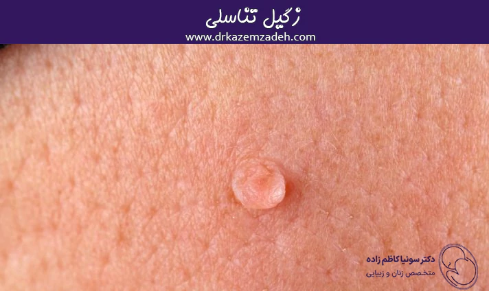 زگیل تناسلی