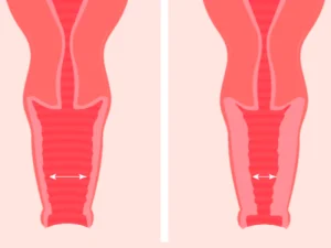 هزینه جراحی تنگ کردن واژن