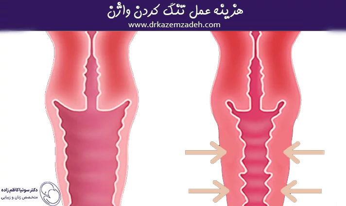 هزینه عمل تنگ کردن واژن