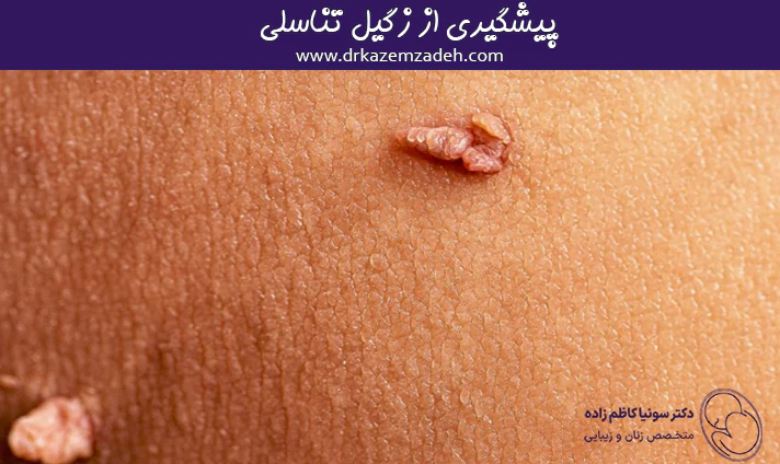 پیشگیری از زگیل تناسلی