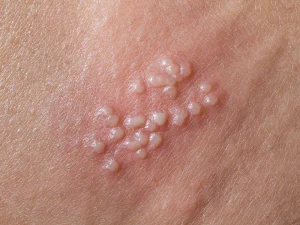 پیشگیری از زگیل تناسلی