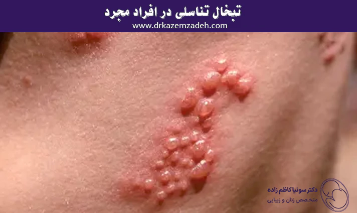 تبخال تناسلی در افراد مجرد