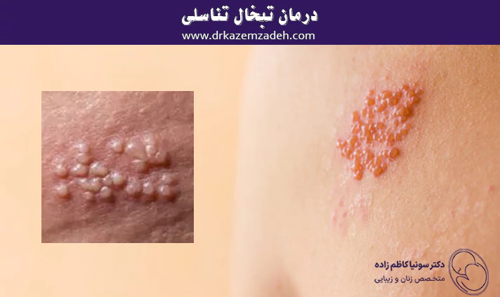 درمان تبخال تناسلی