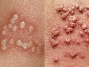 روش های درمان تبخال تناسلی