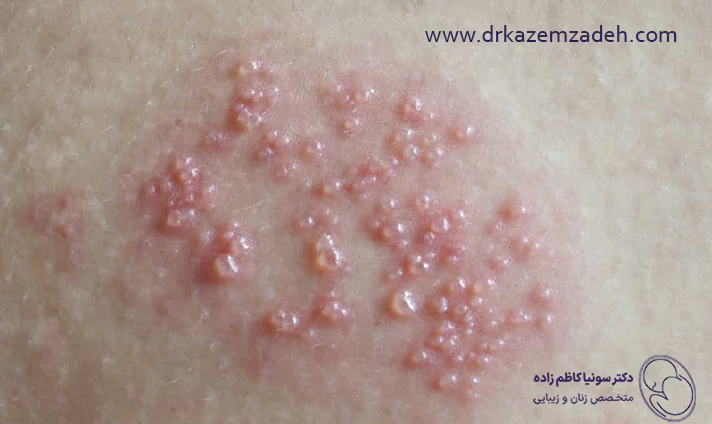 علائم تبخال تناسلی در افراد مجرد