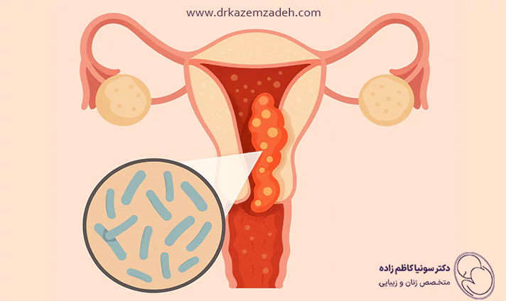 علت عفونت مکرر زنان